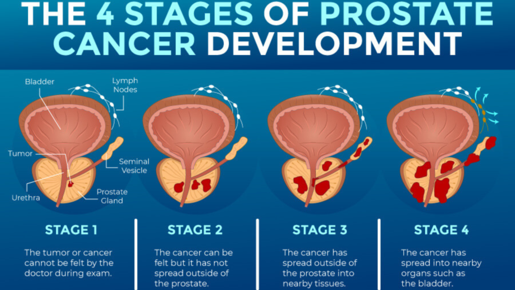 Prostate Cancer